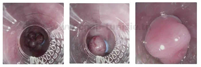 Kit de ligature pour varice œsophagiennes tunisie